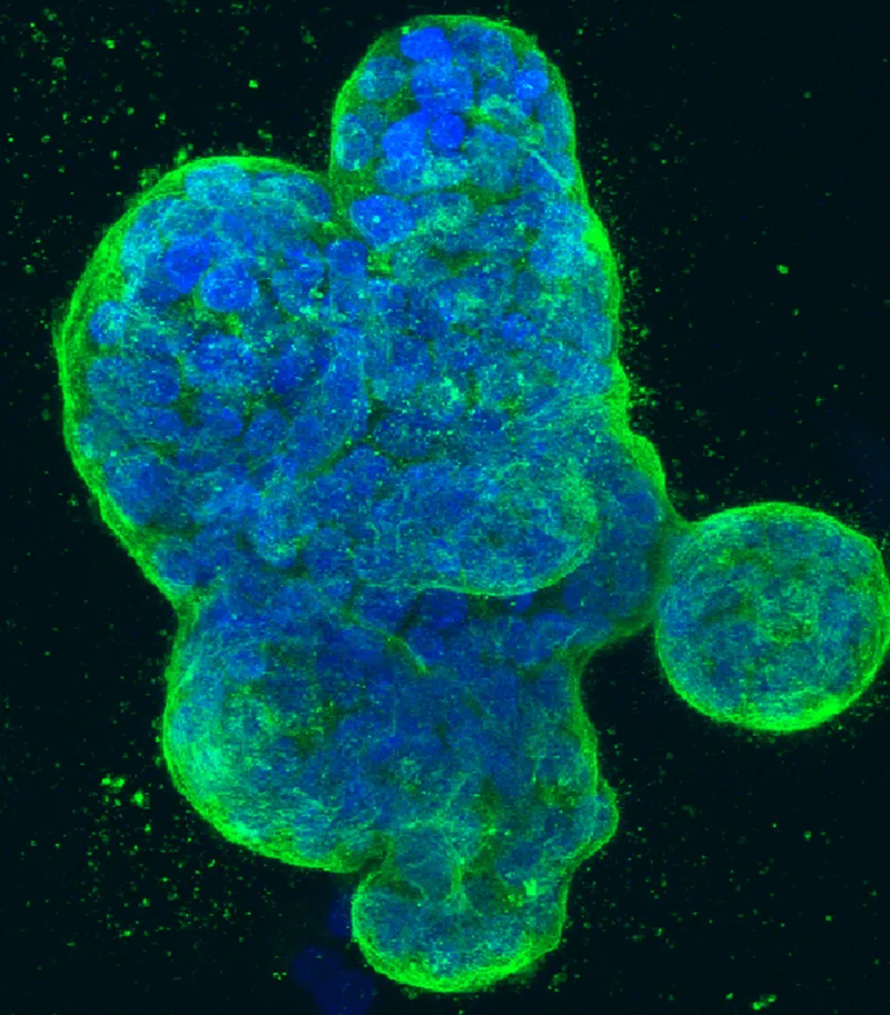 Des scientifiques australiens identifient un moteur clé du cancer du sein agressif