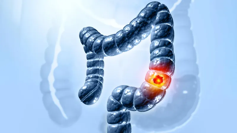 Le rôle d'une bactérie intestinale dans le cancer du côlon révélé