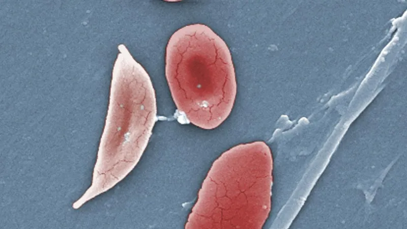 L'Inde révise les directives d'Anaemia Mukt Bharat