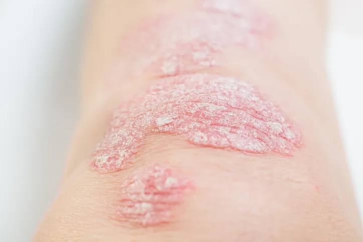 Combinaison d'ixékizumab et de tirzepatide pour le psoriasis et l'obésité