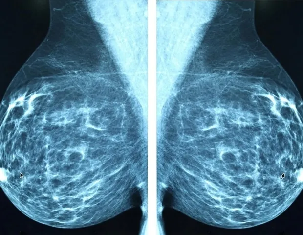 L'endoxifène à faible dose réduit la densité mammaire sans effets secondaires