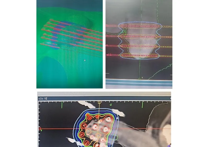 Curiethérapie 3D marocaine pour cancer du gland publiée