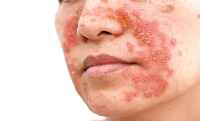 Psoriasis : risque d'infection grave faible avec les biothérapies