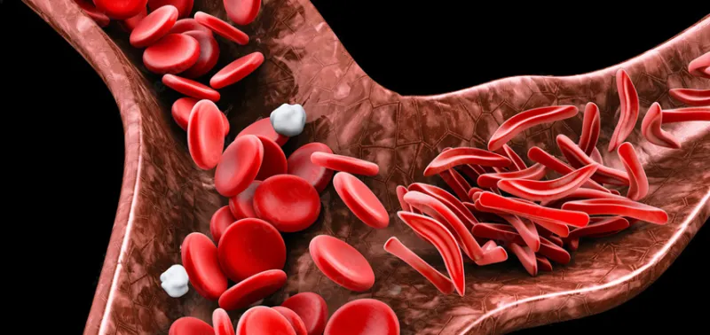 Fardeau de la drépanocytose au Nigeria : les experts appellent à agir