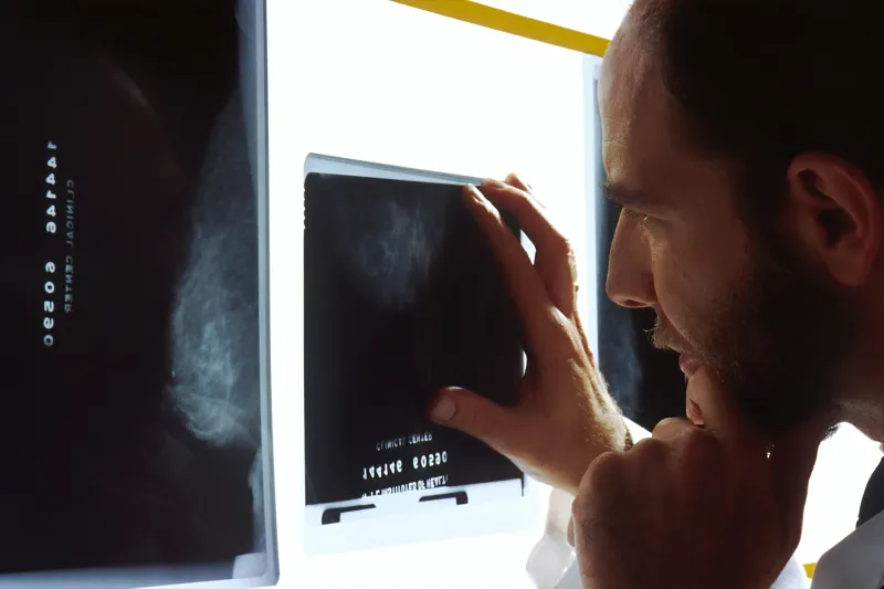 L'acide tranexamique pourrait réduire le risque d'insuffisance hépatique